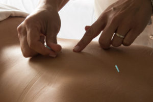 Acupuncture Session Tany